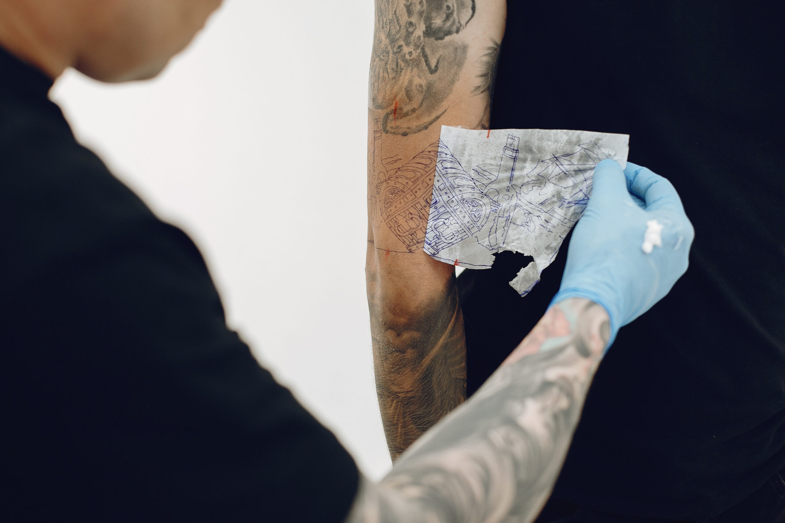 what to expect during laser tattoo removal